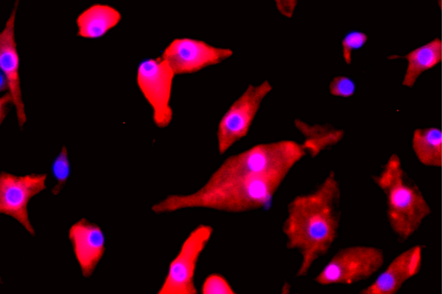 A microscope image of natural killer cells used in this Florida State University research. The purple circles show the cell nucleus and the red shapes show the cytoplasm. The FSU researchers showed the possibility of enhancing natural killer immune cells to improve their ability to attack a rare pediatric brain cancer. (Courtesy of Amy Sang)