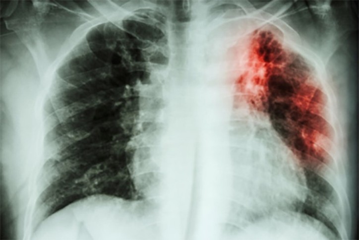 Scan of a lunch with tuberculosis