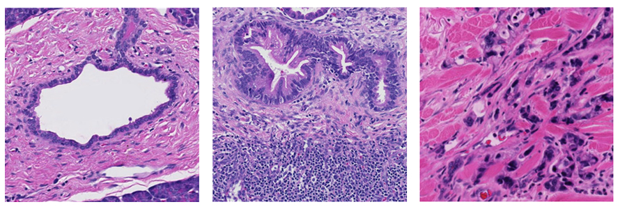 Three histology images showing stained tissue samples with different cellular structures and patterns, including a hollow vessel-like space, gland-like formations, and fibrous tissue containing dark-stained cells.